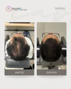 Tratamento para Calvíce