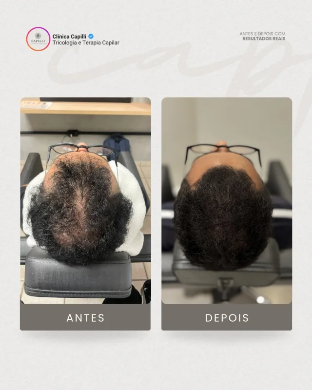 Tratamento para Calvíce